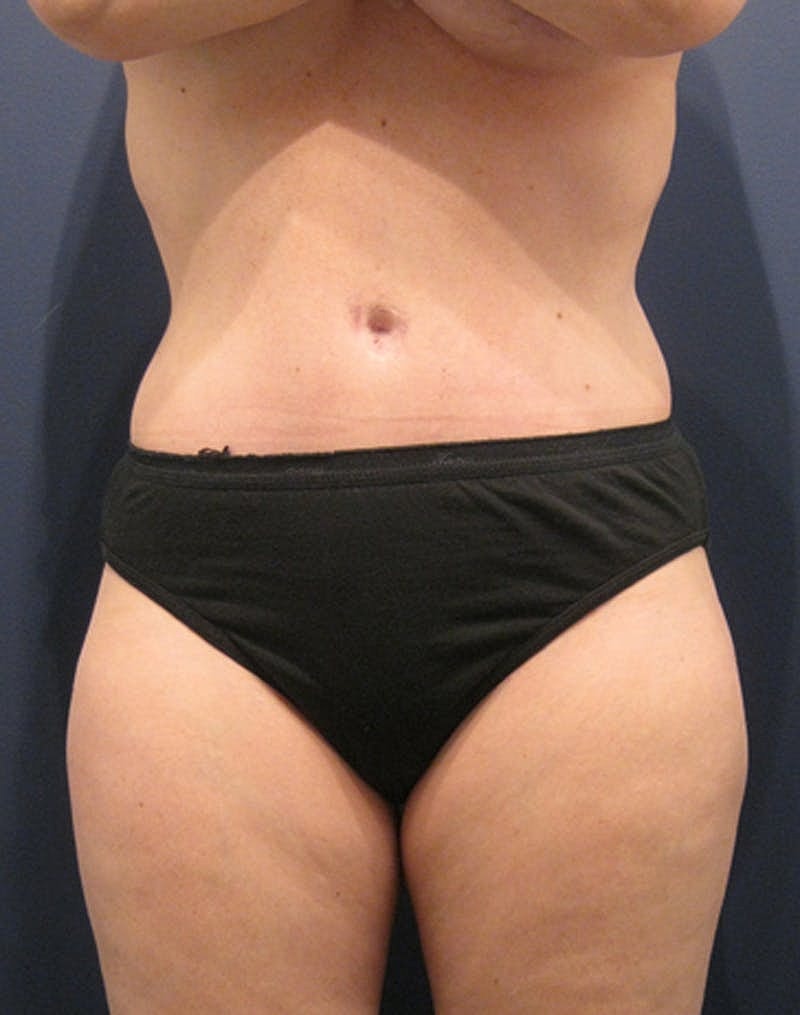 Mommy Makeover Before & After