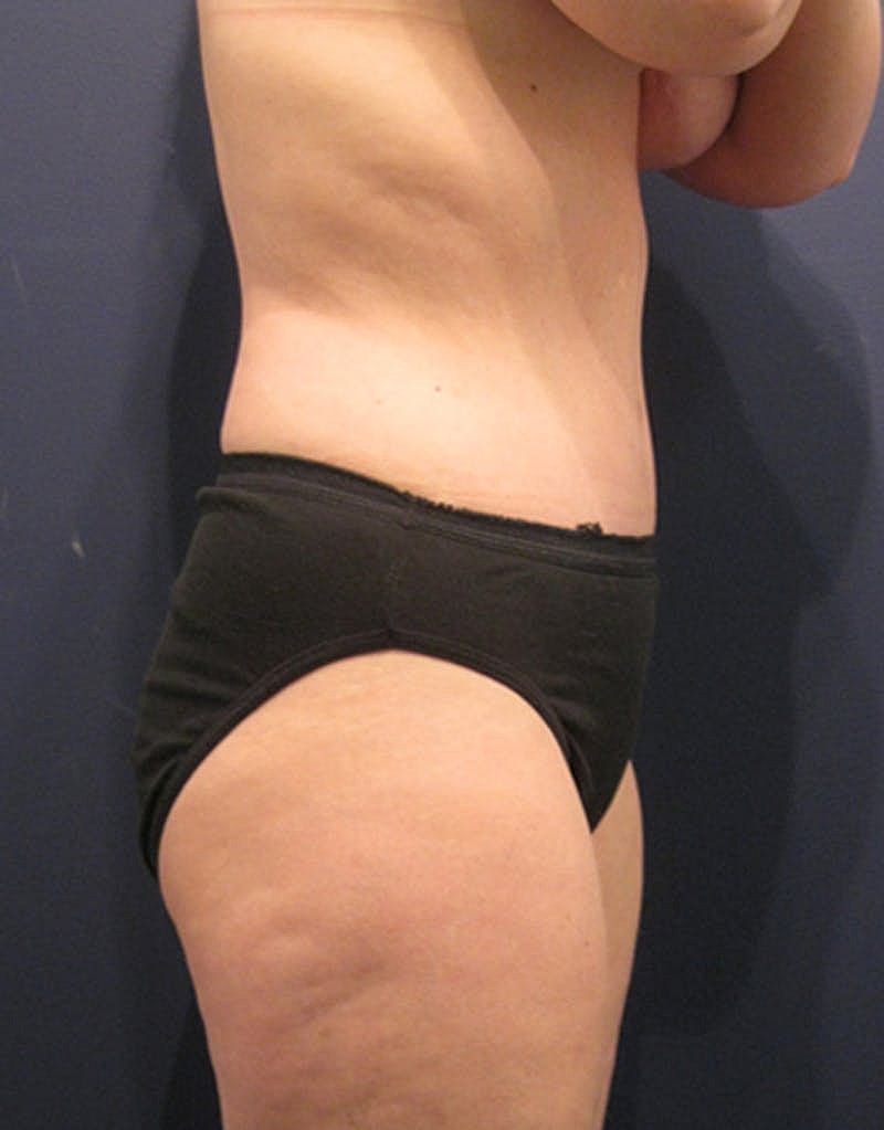 Mommy Makeover Before & After