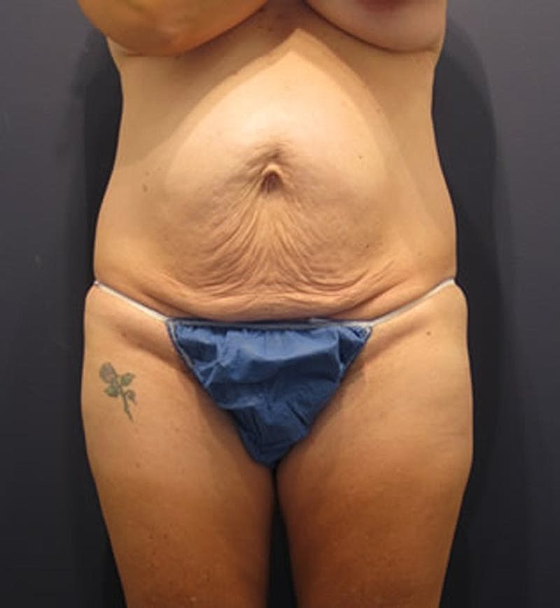 Mommy Makeover Before & After