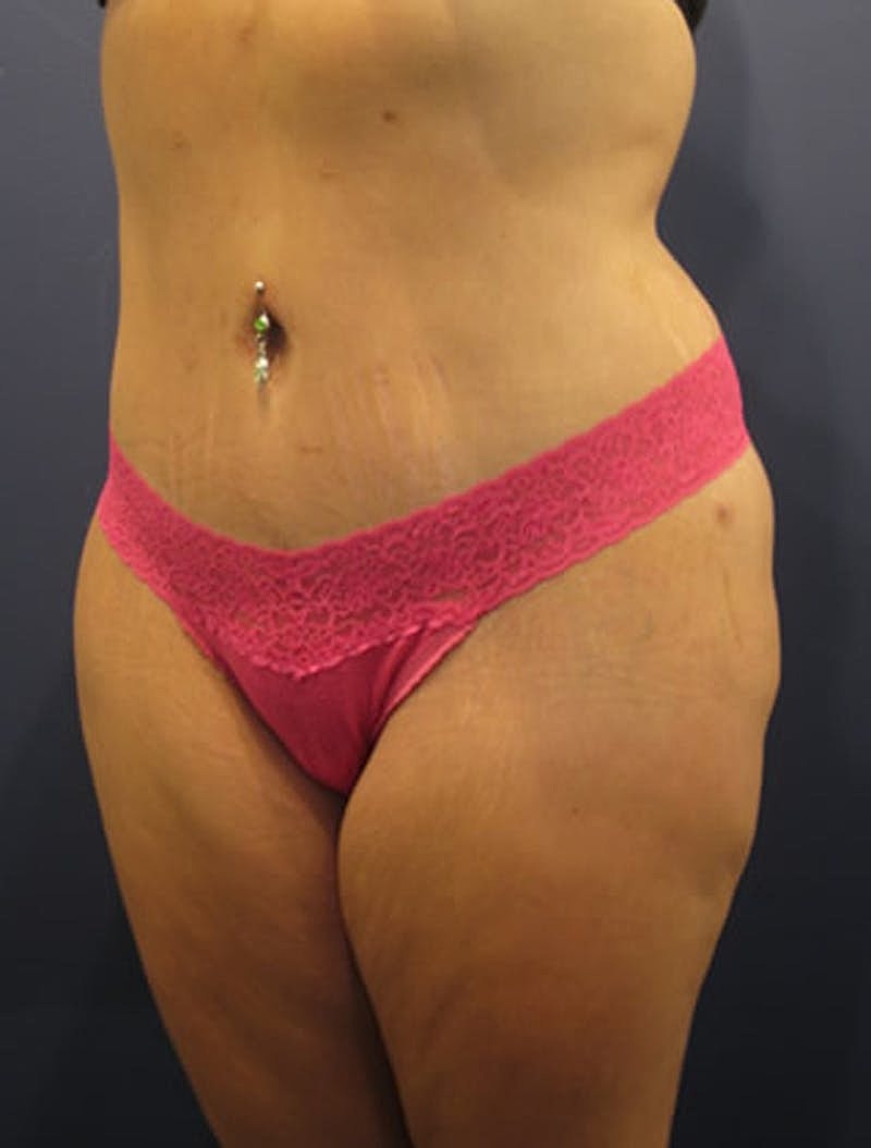 Mommy Makeover Before & After