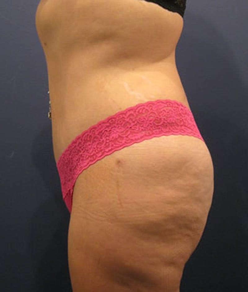 Mommy Makeover Before & After