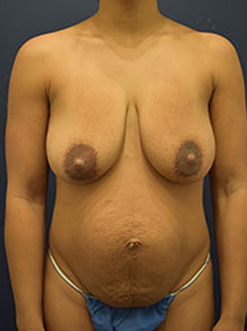 Mommy Makeover Before & After