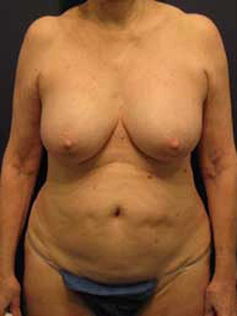 Mommy Makeover Before & After