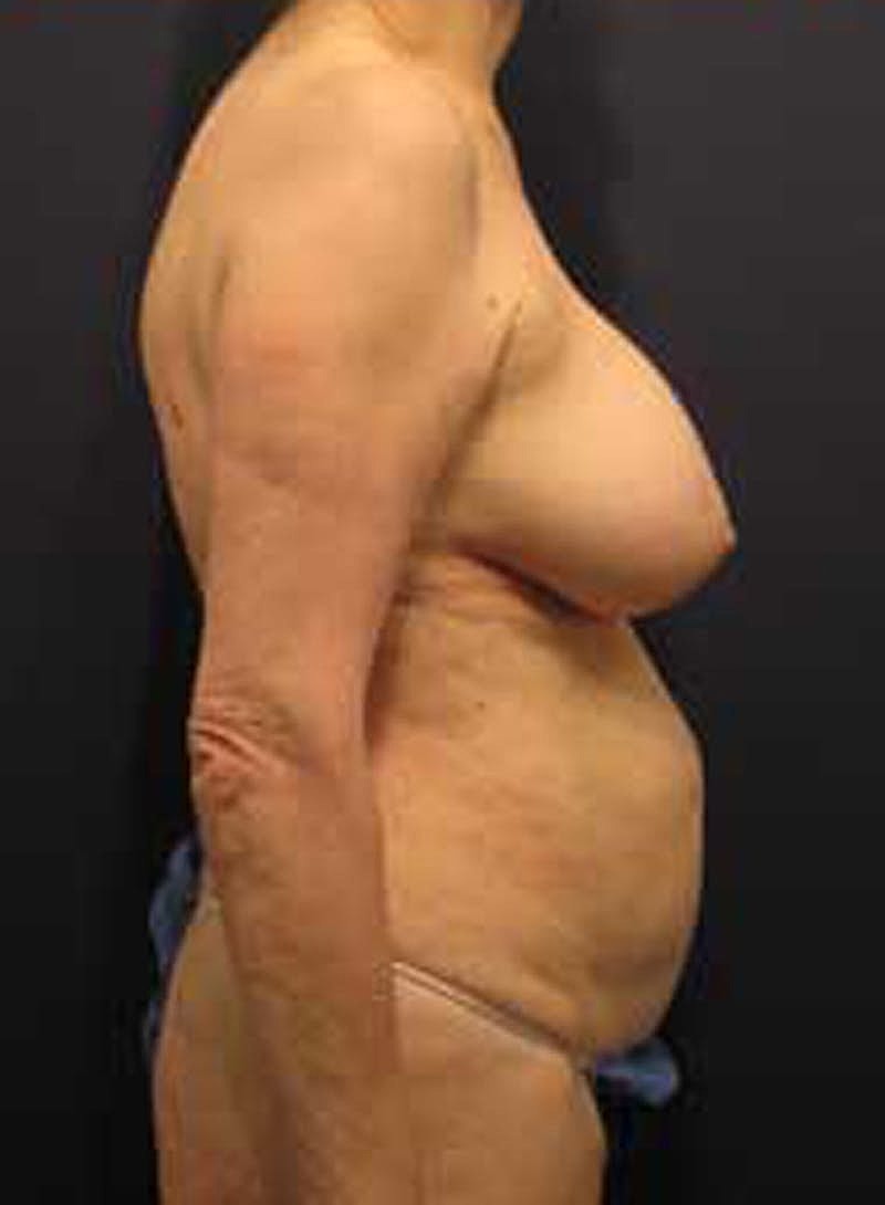 Mommy Makeover Before & After