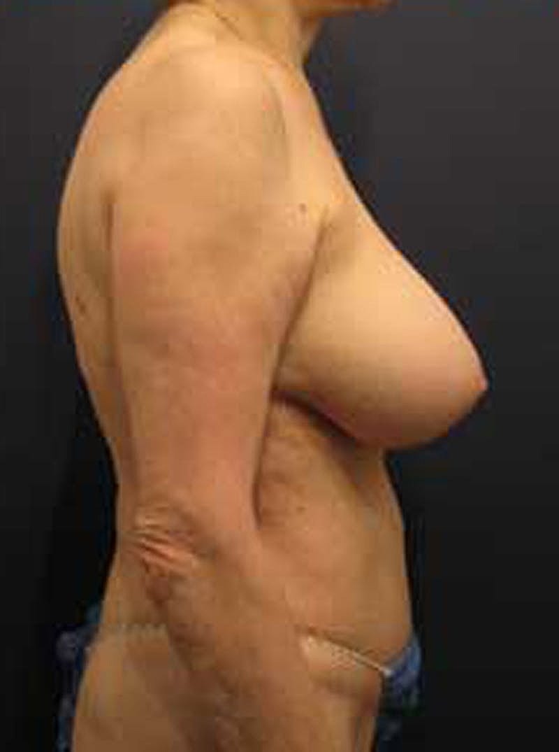 Mommy Makeover Before & After