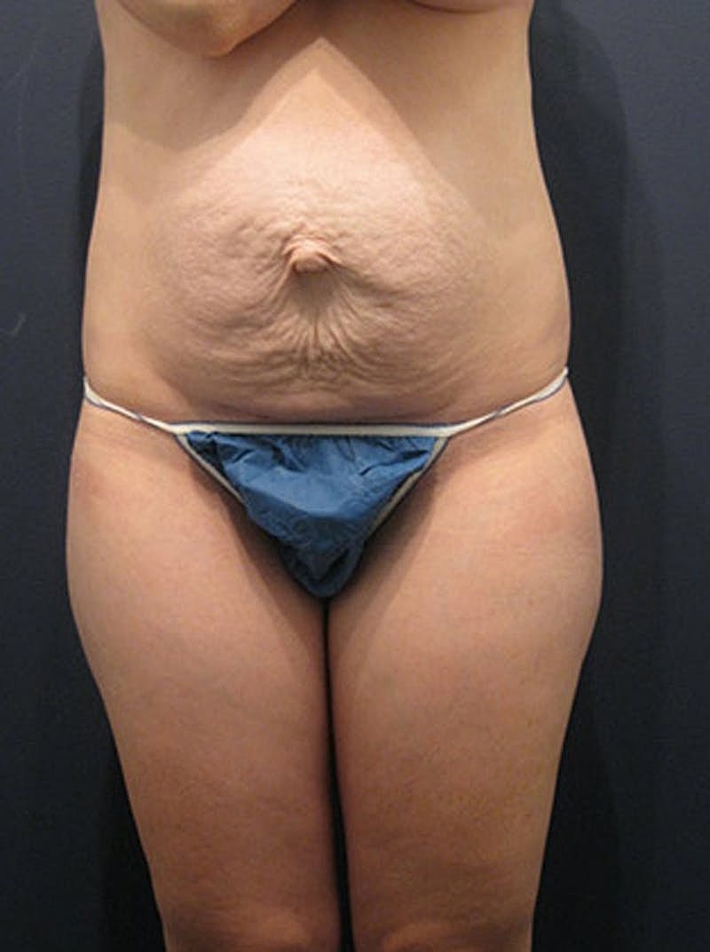 Mommy Makeover Before & After