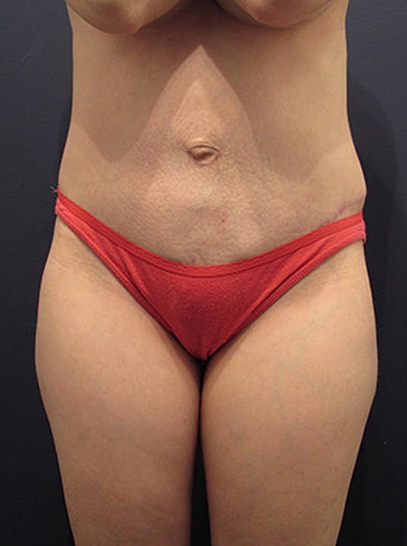 Mommy Makeover Before & After