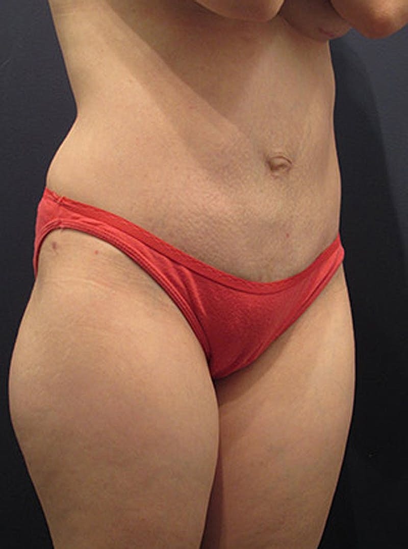 Mommy Makeover Before & After