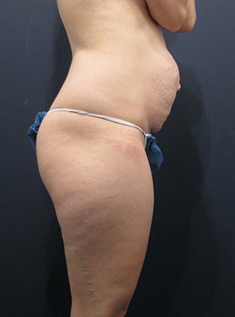 Mommy Makeover Before & After