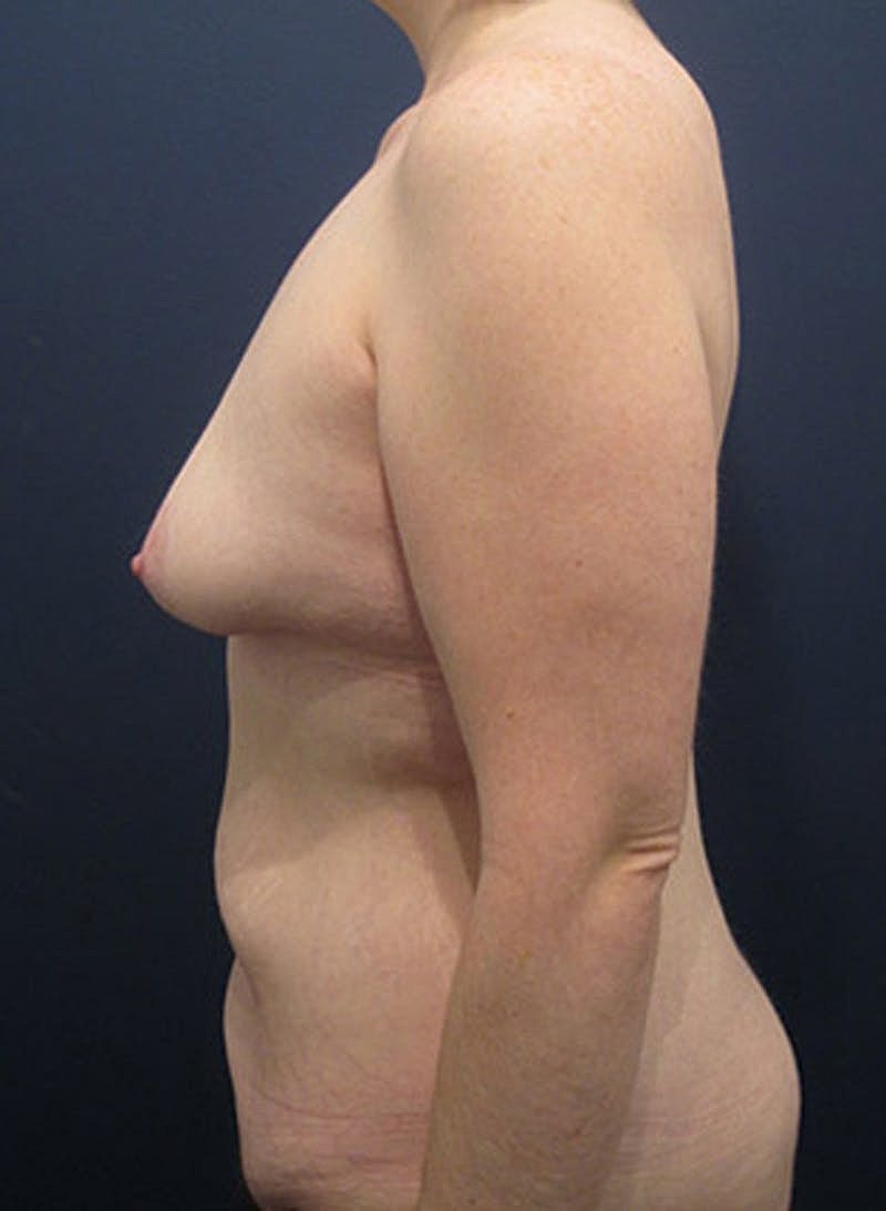 Mommy Makeover Before & After