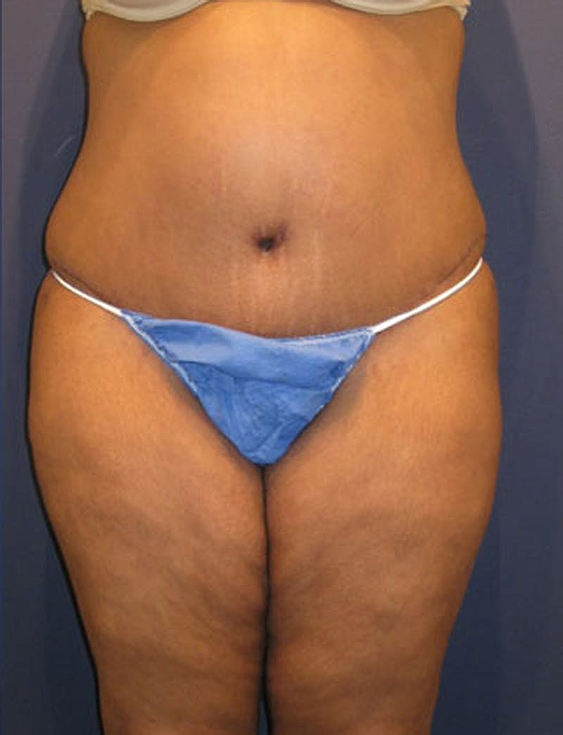 Mommy Makeover Before & After