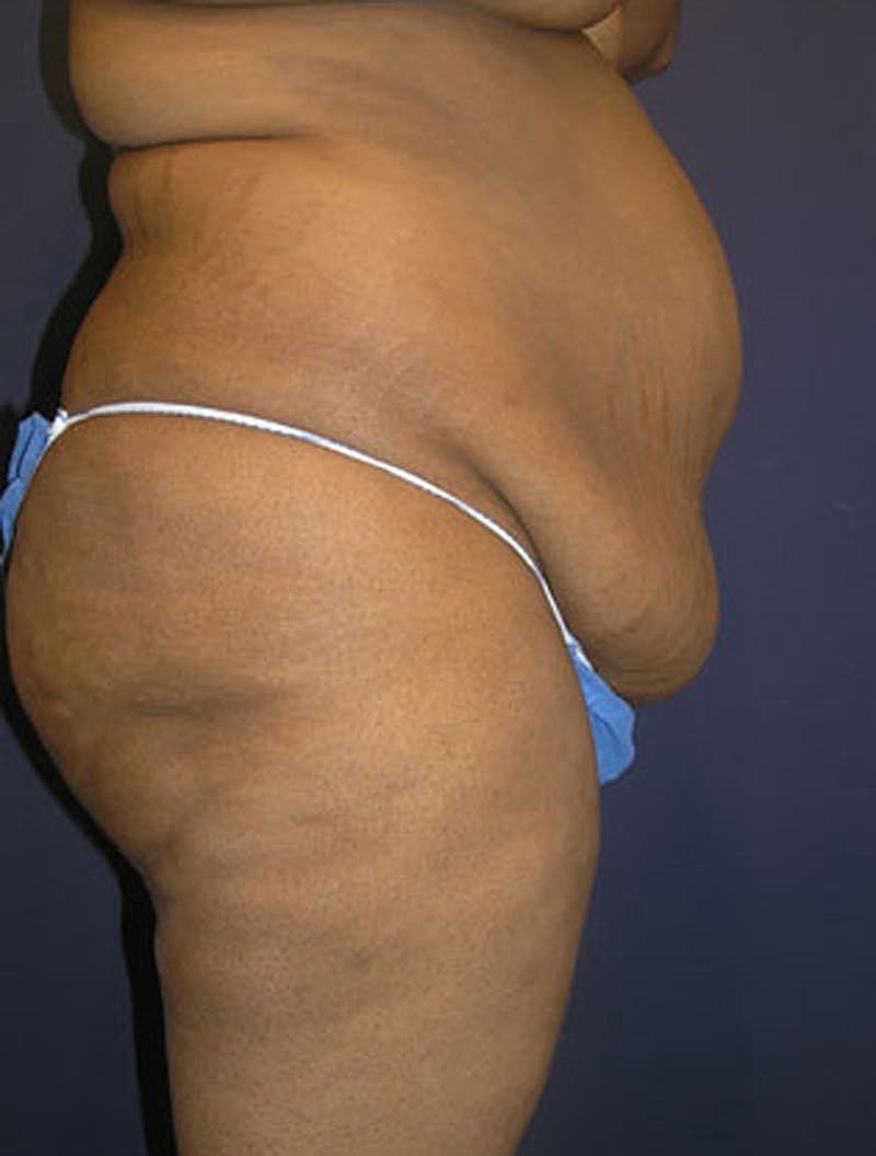 Mommy Makeover Before & After