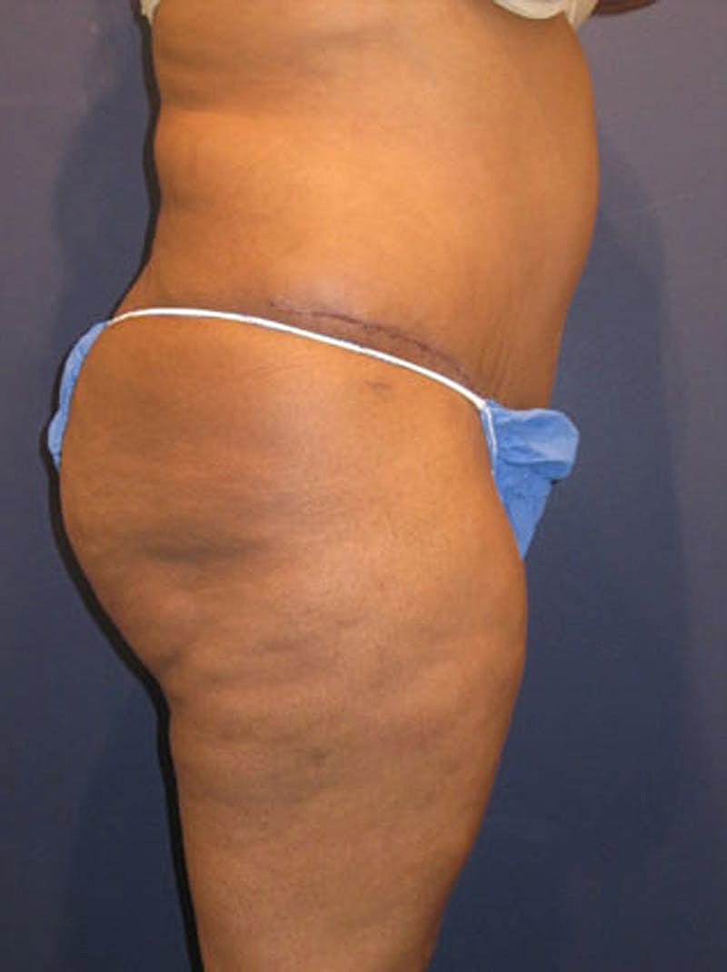 Mommy Makeover Before & After