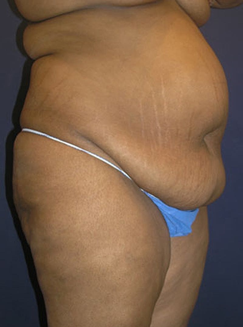 Mommy Makeover Before & After