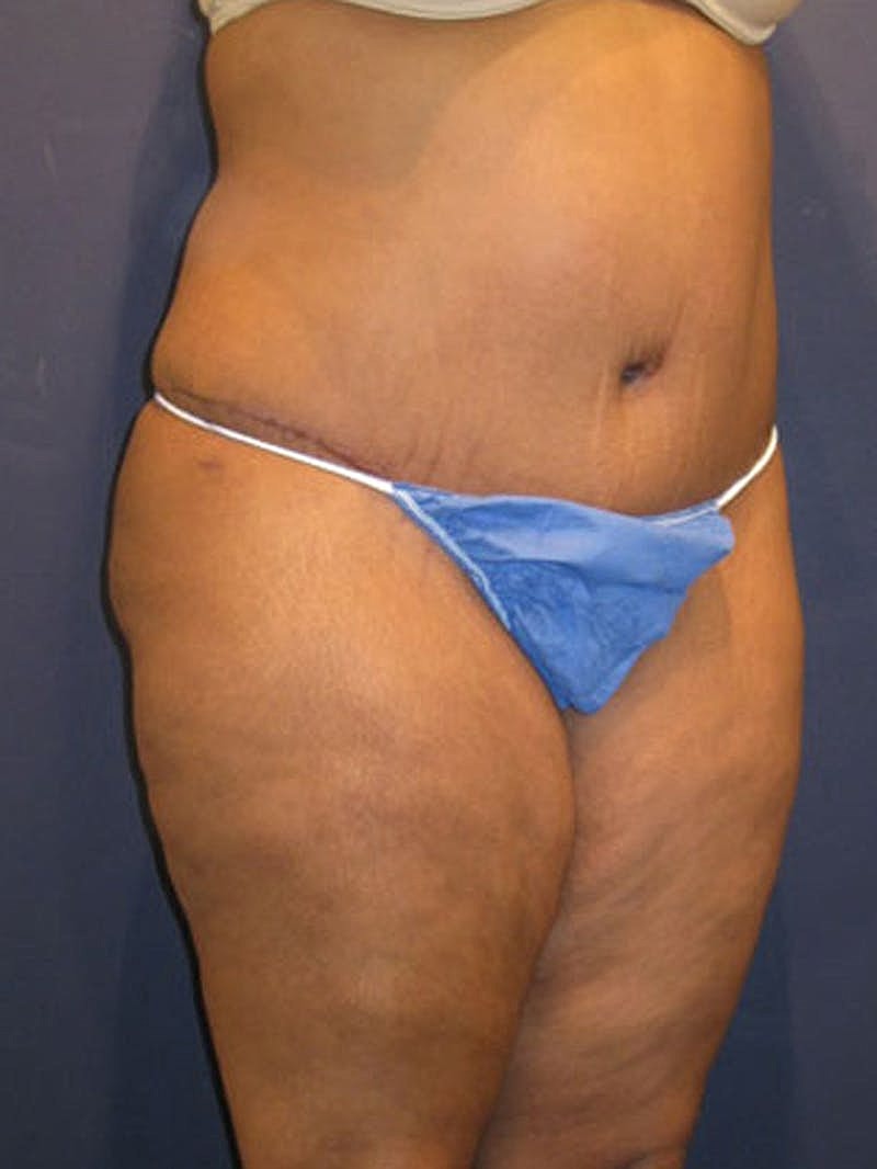 Mommy Makeover Before & After