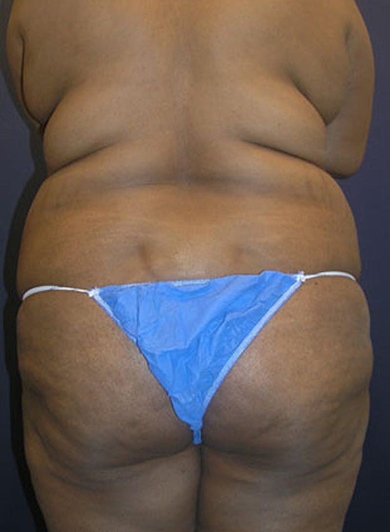 Mommy Makeover Before & After