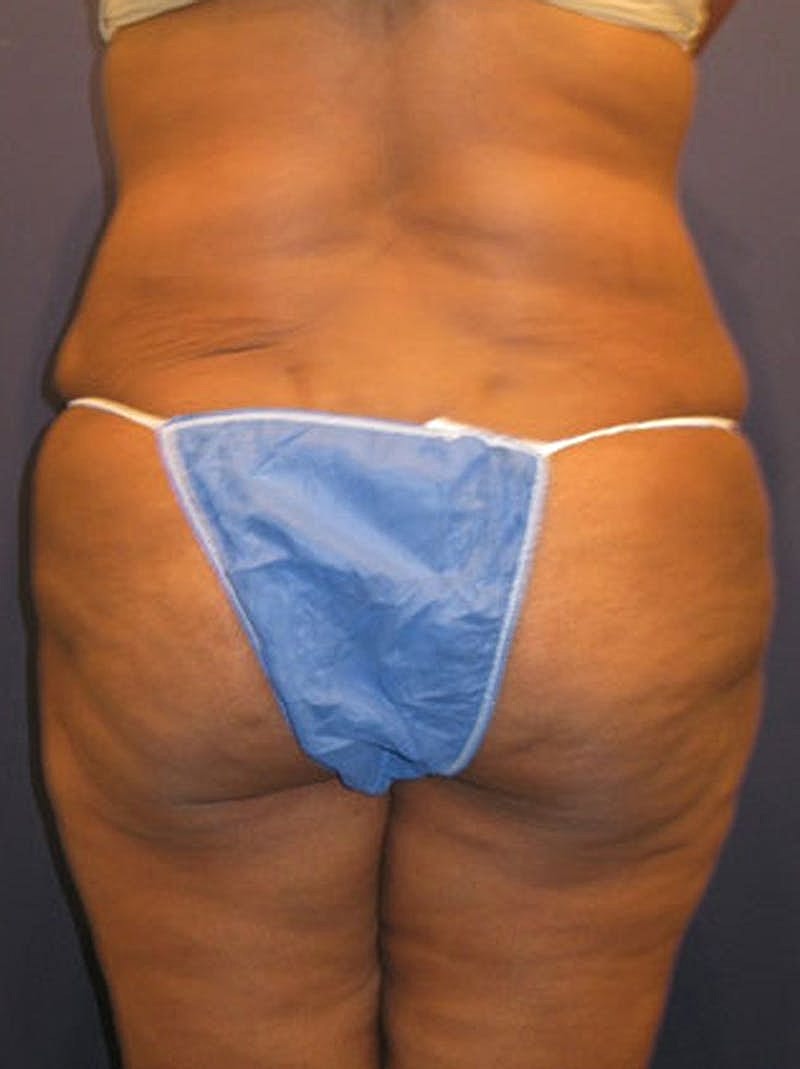 Mommy Makeover Before & After