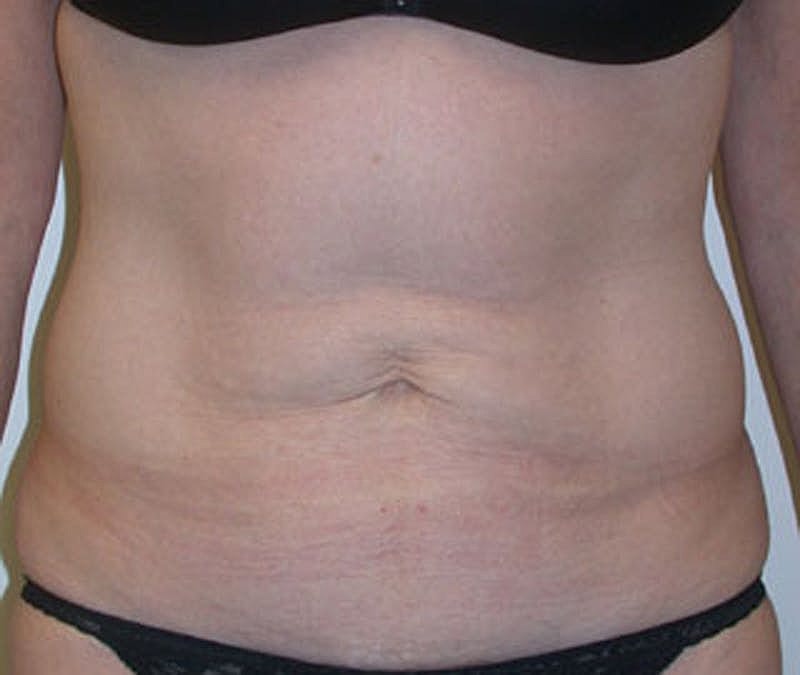 Mommy Makeover Before & After