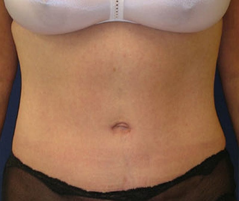 Mommy Makeover Before & After