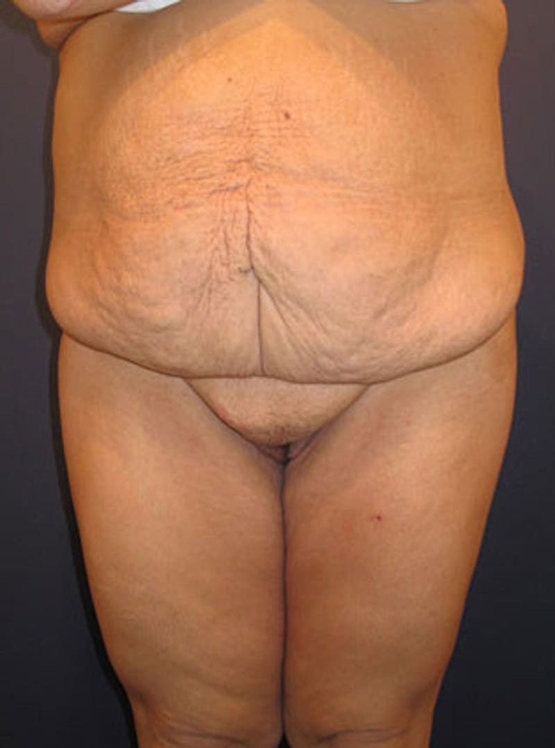 Mommy Makeover Before & After