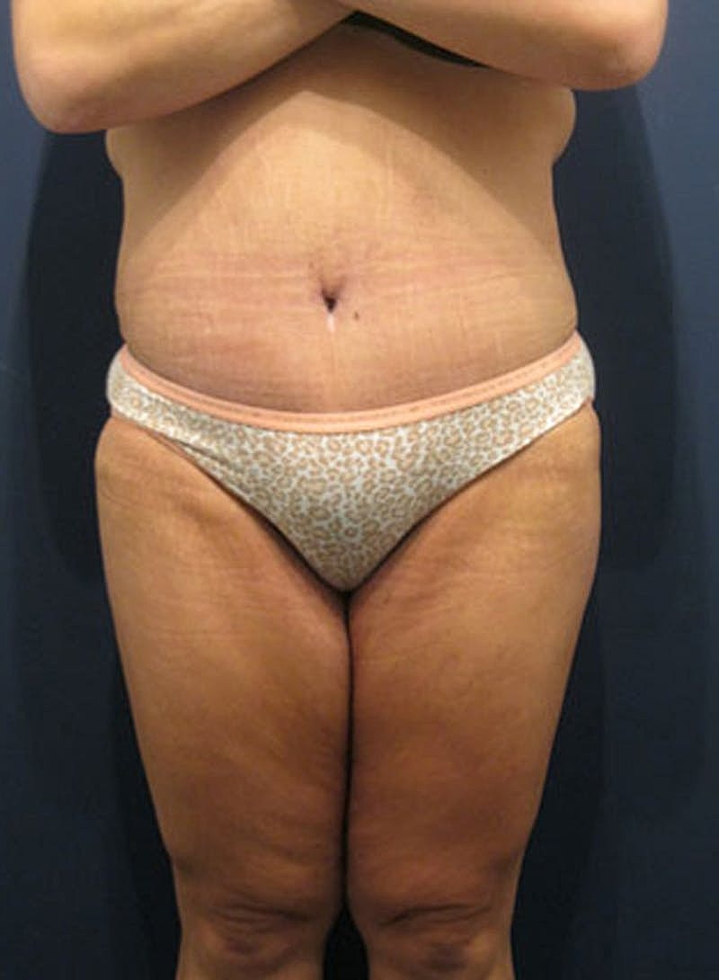 Mommy Makeover Before & After