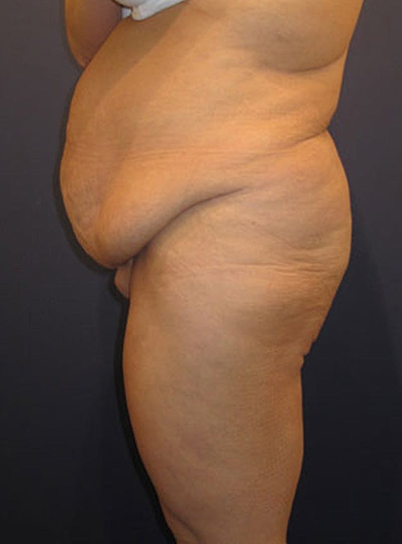 Mommy Makeover Before & After