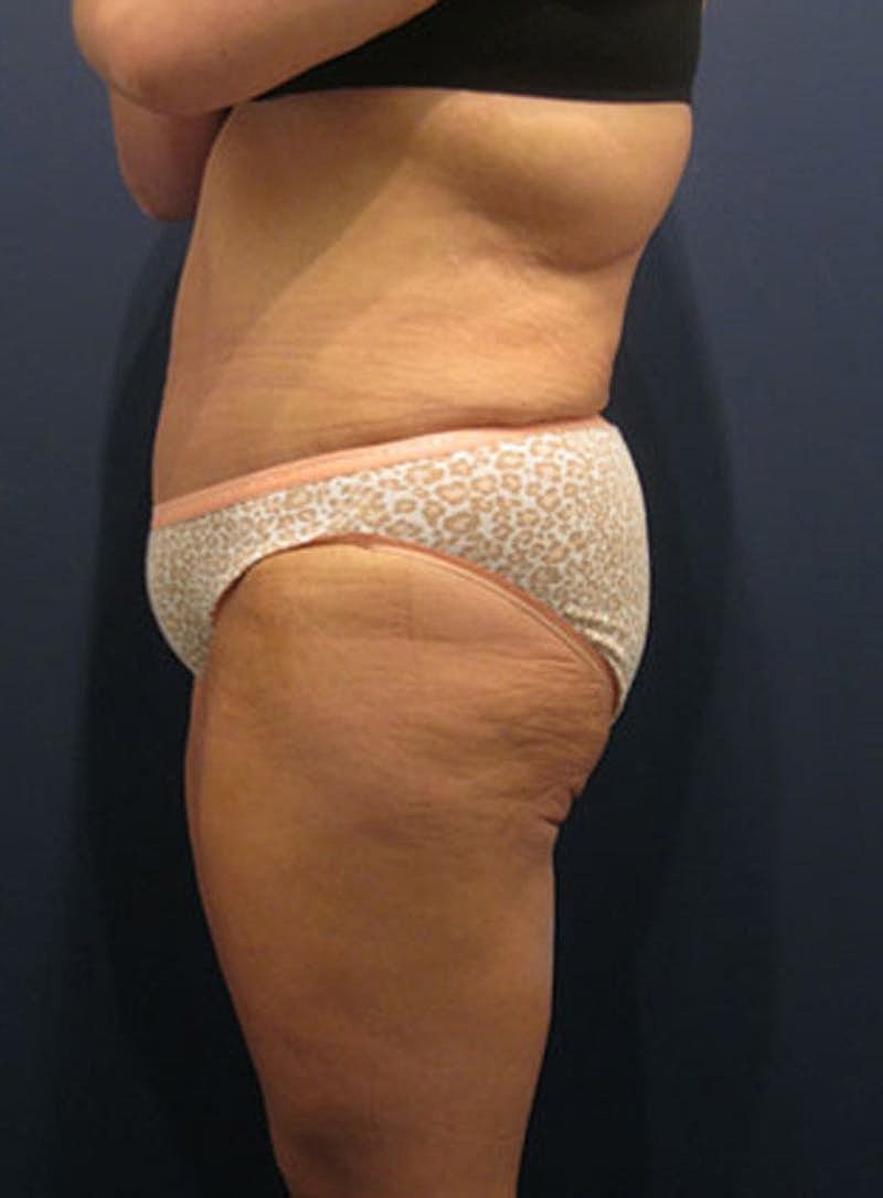 Mommy Makeover Before & After