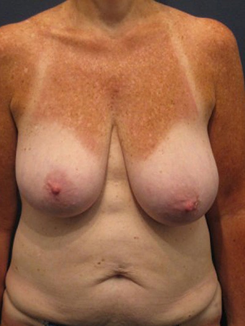 Mommy Makeover Before & After