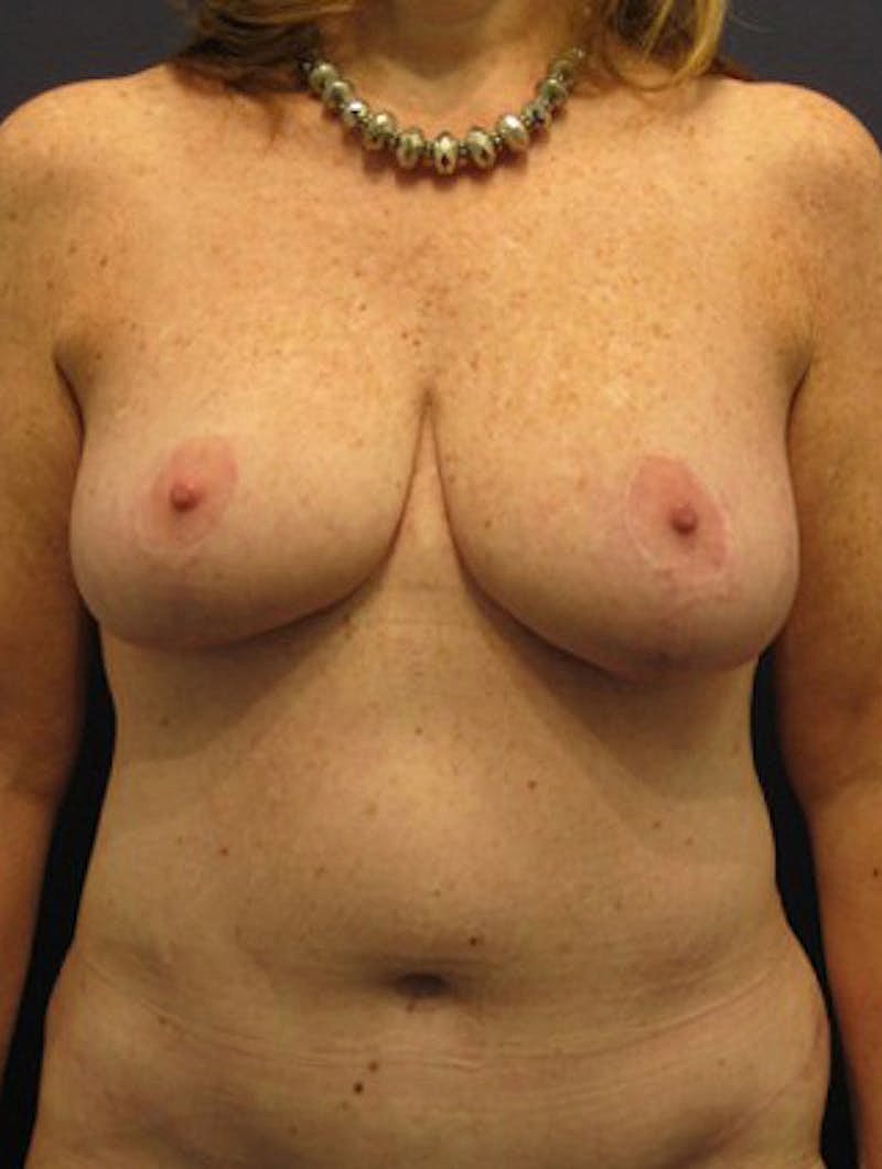 Mommy Makeover Before & After