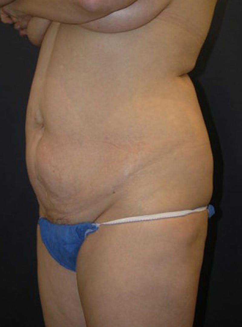 Mommy Makeover Before & After