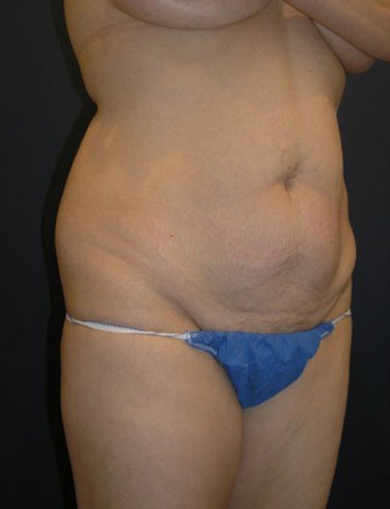 Mommy Makeover Before & After