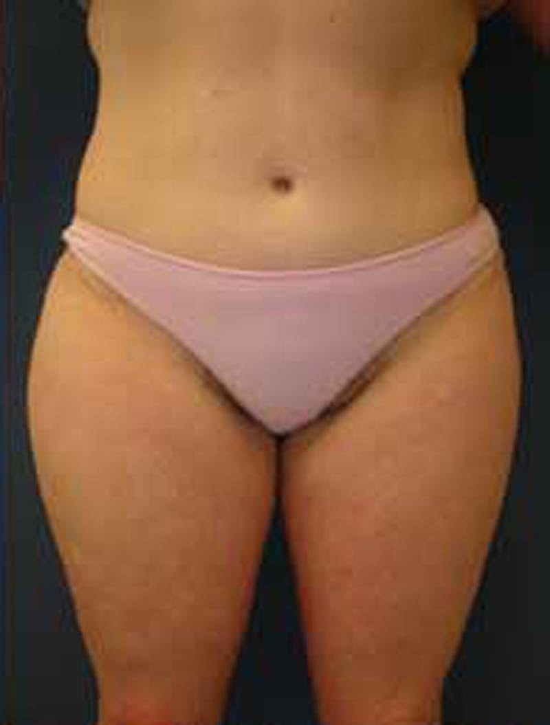 Mommy Makeover Before & After