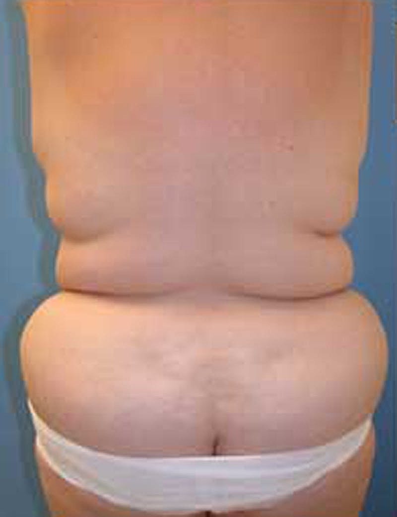 Mommy Makeover Before & After