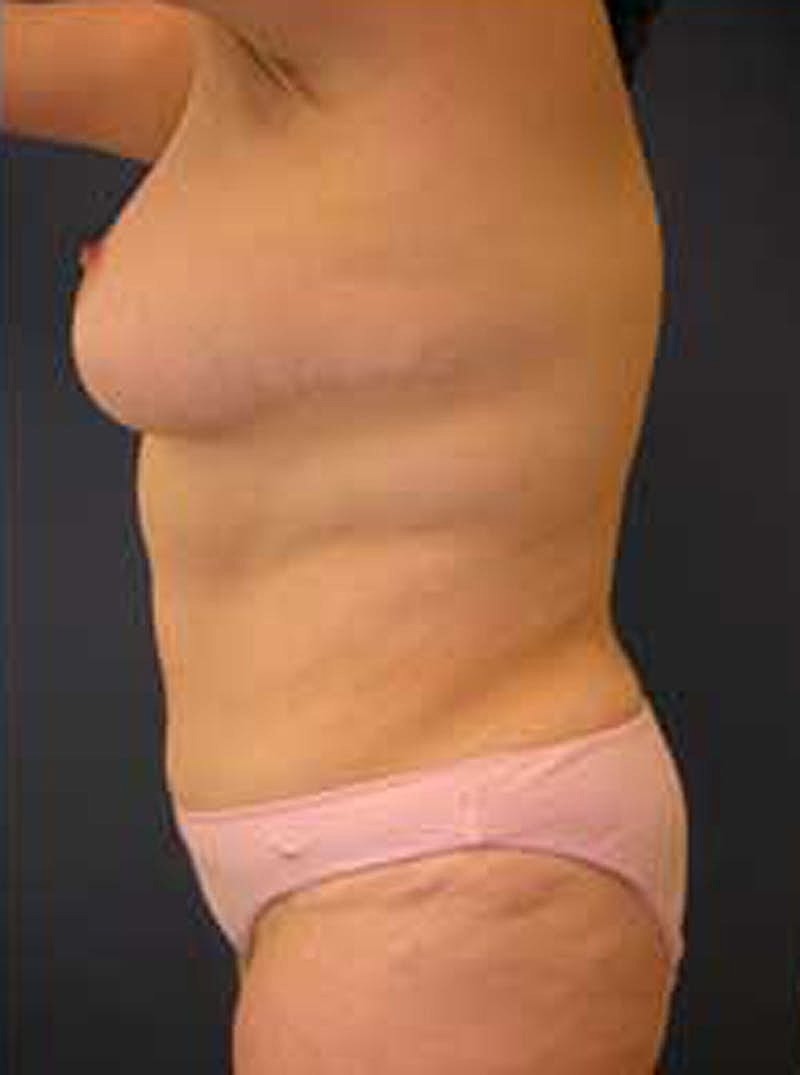 Mommy Makeover Before & After