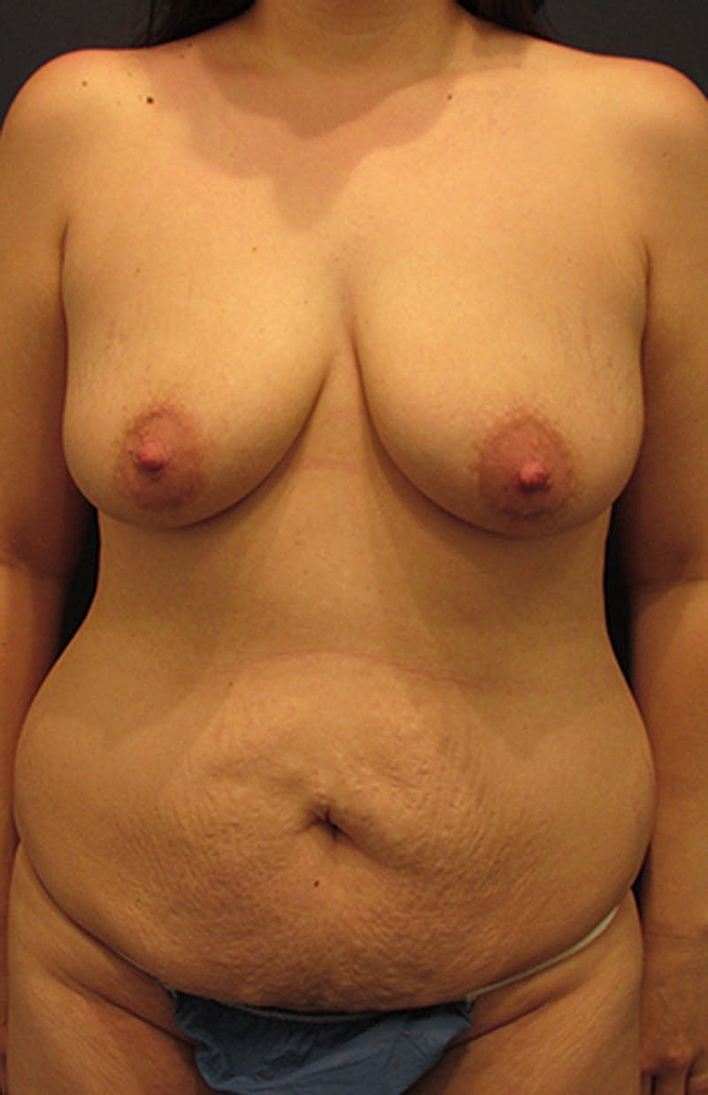 Mommy Makeover Before & After