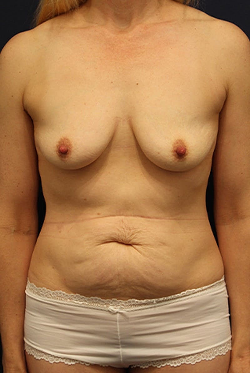 Mommy Makeover Before & After