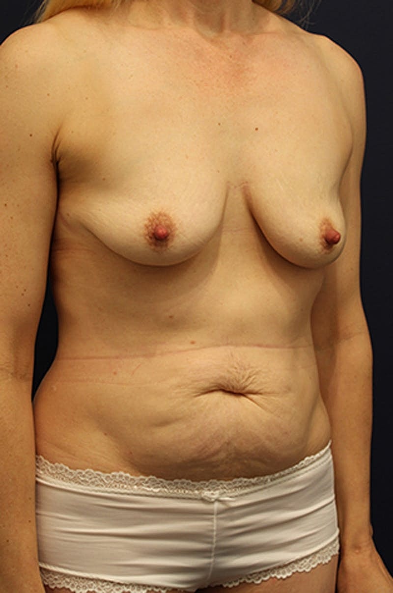 Mommy Makeover Before & After