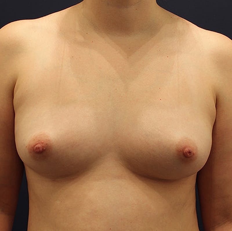 Breast Fat Transfer Before & After