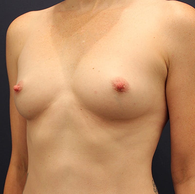 Breast Fat Transfer Before & After