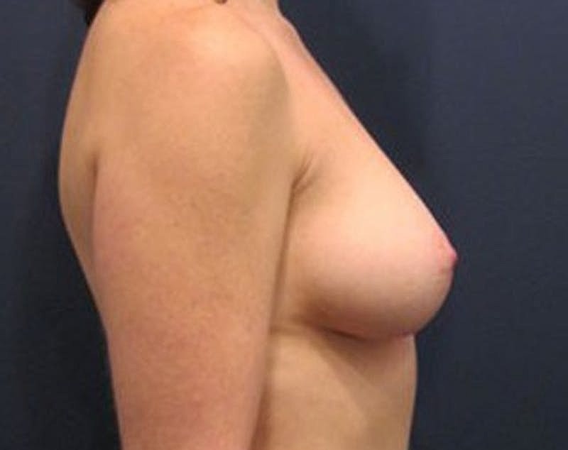 Breast Fat Transfer Before & After