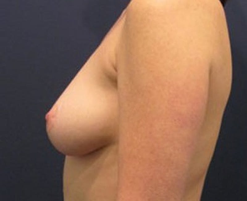 Breast Fat Transfer Before & After