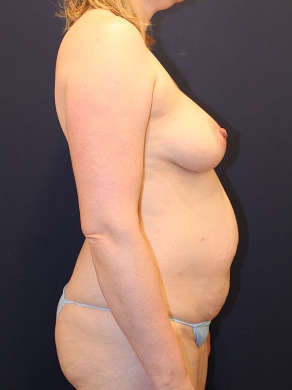 Breast Fat Transfer Before & After