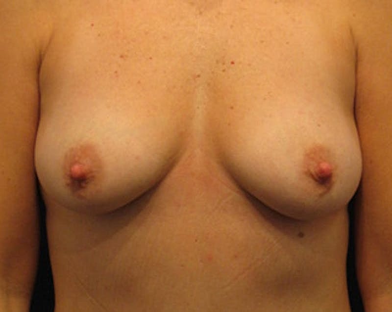Breast Fat Transfer Before & After