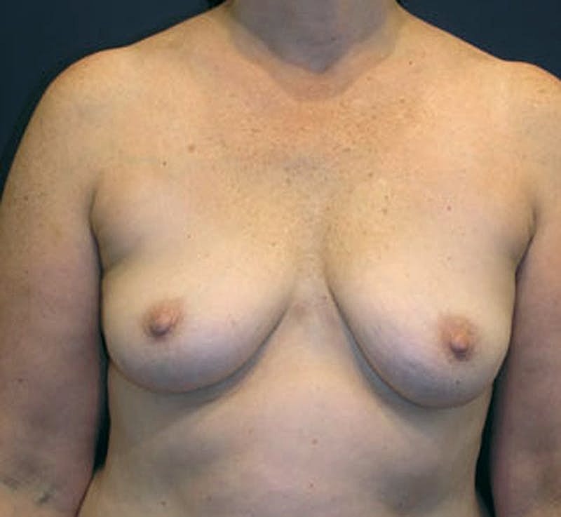 Breast Fat Transfer Before & After