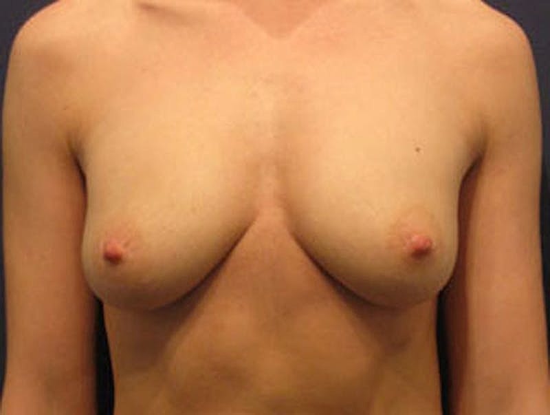 Breast Fat Transfer Before & After