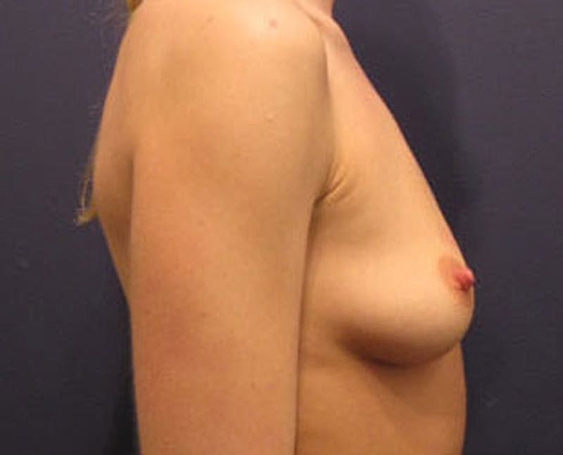 Breast Fat Transfer Before & After
