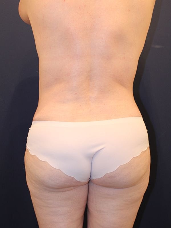 Breast Fat Transfer Before & After