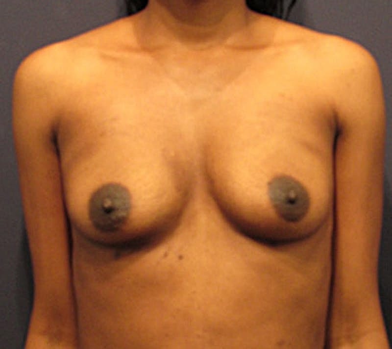 Breast Fat Transfer Before & After