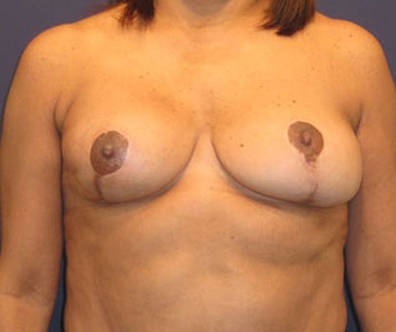 Breast Fat Transfer Before & After