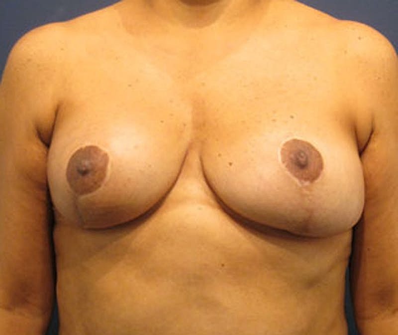 Breast Fat Transfer Before & After